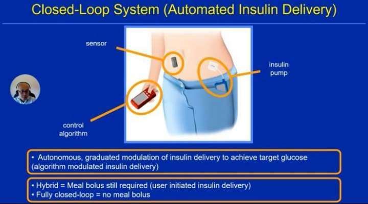 الكشف عن جهاز البنكرياس الصناعي لقياس السكر