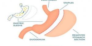 ما هي أضرار عملية تحويل مسار المعدة على المدى البعيد؟ دكتور أسامة خليل