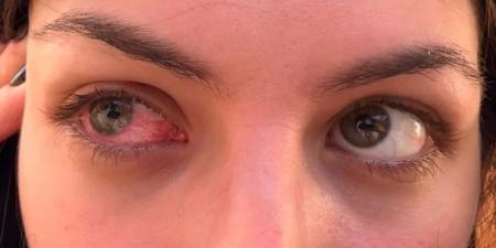 خطأ بسيط قد يكلّفك عينيك .. لا تضعوا العدسات اللاصقة بهذه الطريقة