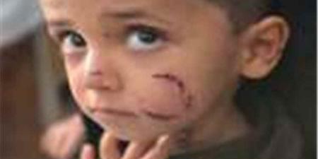 طفل يتعرض لهجوم كلب ضال في وجهه بتعز.. والأهالي يطلقون صرخة استغاثة (تفاصيل)