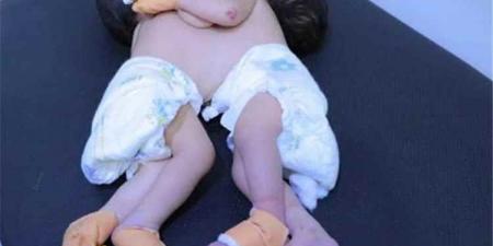 نداء إنساني عاجل لإنقاذ توأم سيامي في صنعاء