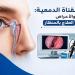 انسداد القناة الدمعية.. الأسباب والأعراض وأحدث طرق العلاج بالمنظار