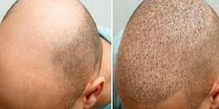 زراعة الشعر بدون ألم .. 6 آثار جانبية محتملة