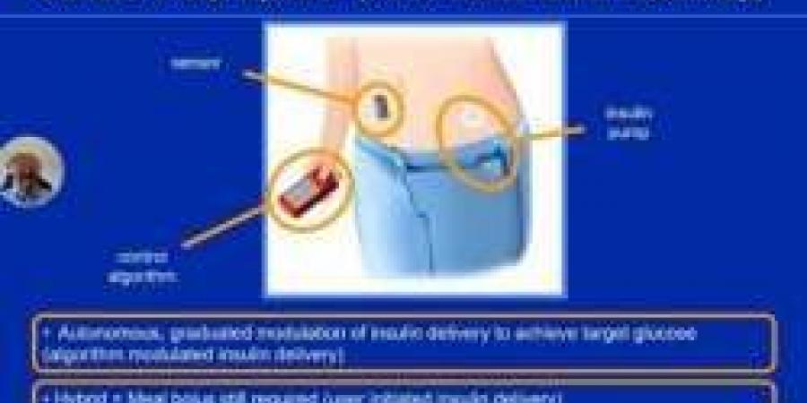 خلال مستجدات أمراض السكري: الكشف عن جهاز البنكرياس الصناعي لقياس السكر وقت النوم وينهي عمليات وخز الابر