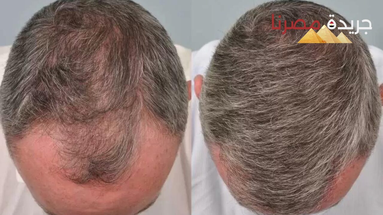 طرق زراعة الشعر وزيادة كثافته